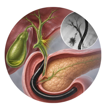 Biliary Leak Evaluation